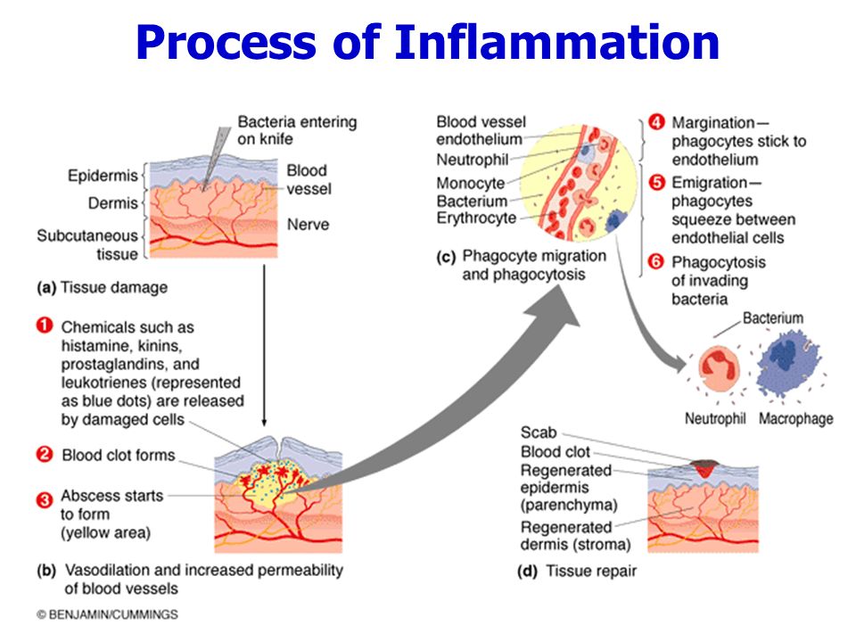 Como reducir la inflamacion